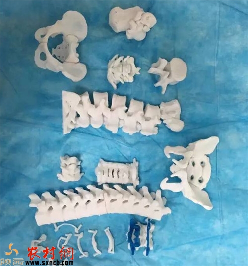 3D打印人體椎骨