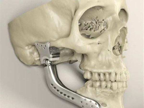 簡述3D打印技術在醫療行業應用情況_e鍵3D打印服務