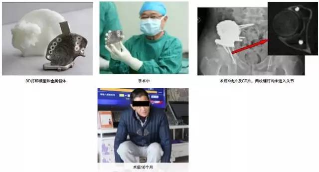3d打印在醫(yī)療領(lǐng)域的應用 3D打印與醫(yī)療行業(yè)白皮書