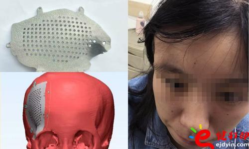 醫(yī)療3d打印應用,醫(yī)用3d打印,3D打印假肢,3D打印脊椎,3D打印心臟,e鍵打印,3d打印服務 3D打印的顱骨假體，非常適用于發(fā)際外的顱骨缺損、病變置換，將使患者的面容恢復到正常形態(tài)，完美解決了傳統(tǒng)顱骨修補存在的美容問題。據悉，3D打印個性化顱骨假體修補技術已獲國家重點研發(fā)計劃資助，能為一批病人免費提供假體，并能減免一些檢查和治療費用。未來將實行72小時的3D假體個性化顱骨修補術，造福更多的患者。